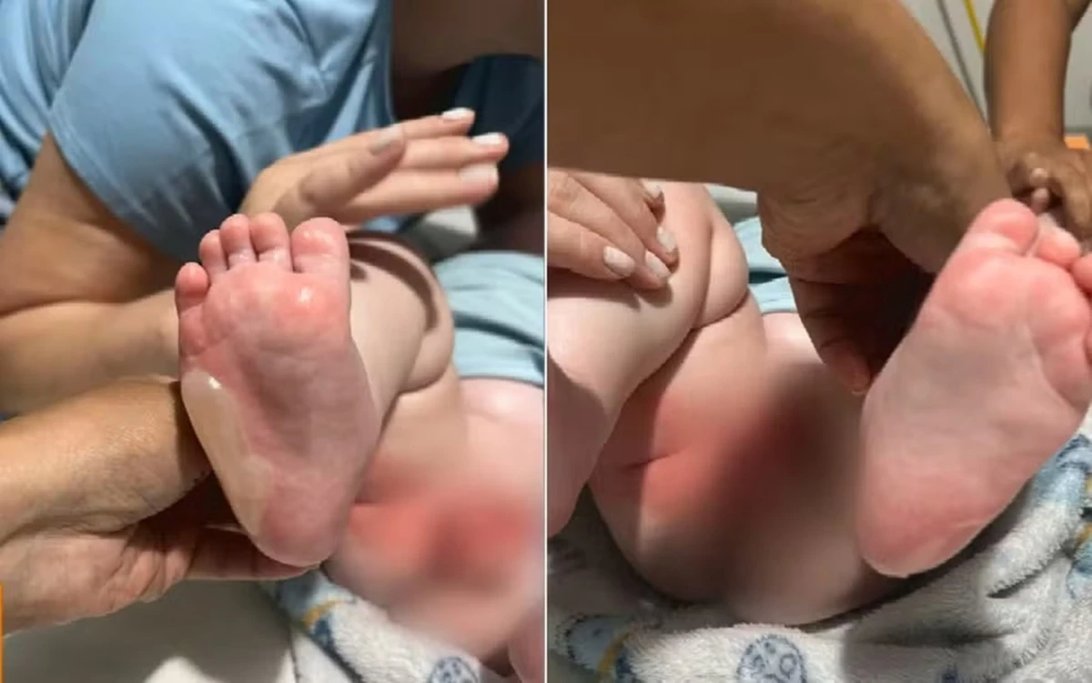 Bebê sofre queimaduras durante banho em berçário: incidente alarmante.