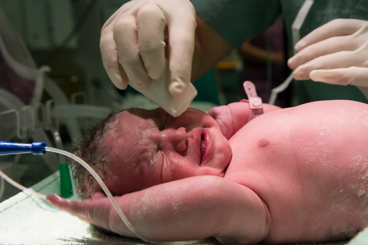 Estudo Revela que Bebês com Herpes Congênita Passam Mais Tempo na UTI