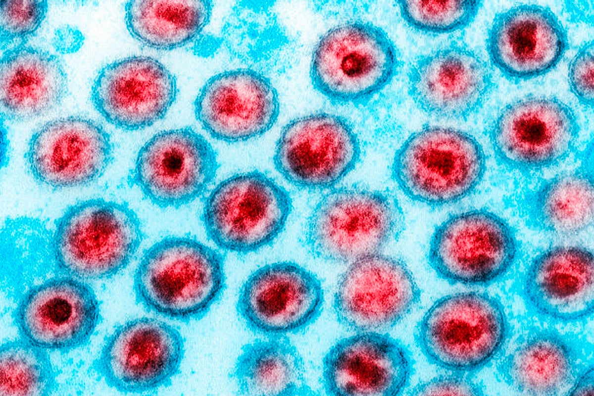 Paciente Alcança Remissão do HIV Após Transplante de Medula Óssea de Irmão